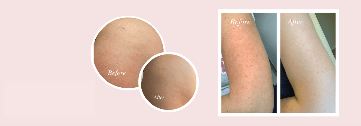How To Get Rid Of Keratosis Pilaris At Home? - MY GLOW 2.