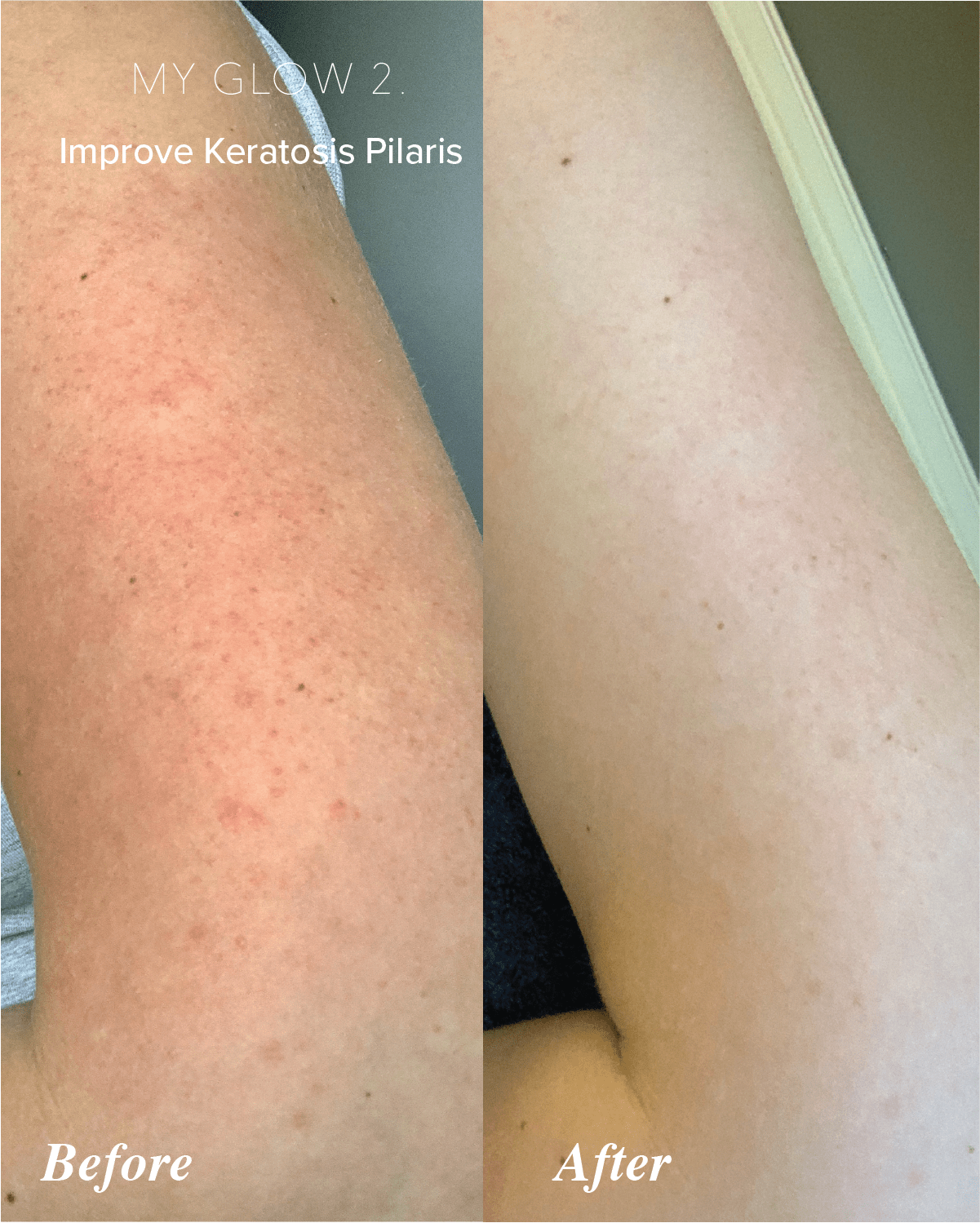 My Glow 2. 5 ways to get rid of ingrown hairs for good My Glow 2